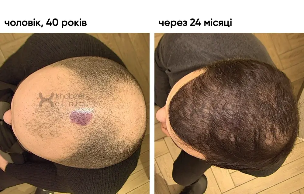 Двоетапна трансплантація волосся: результат через 24 місяці 5