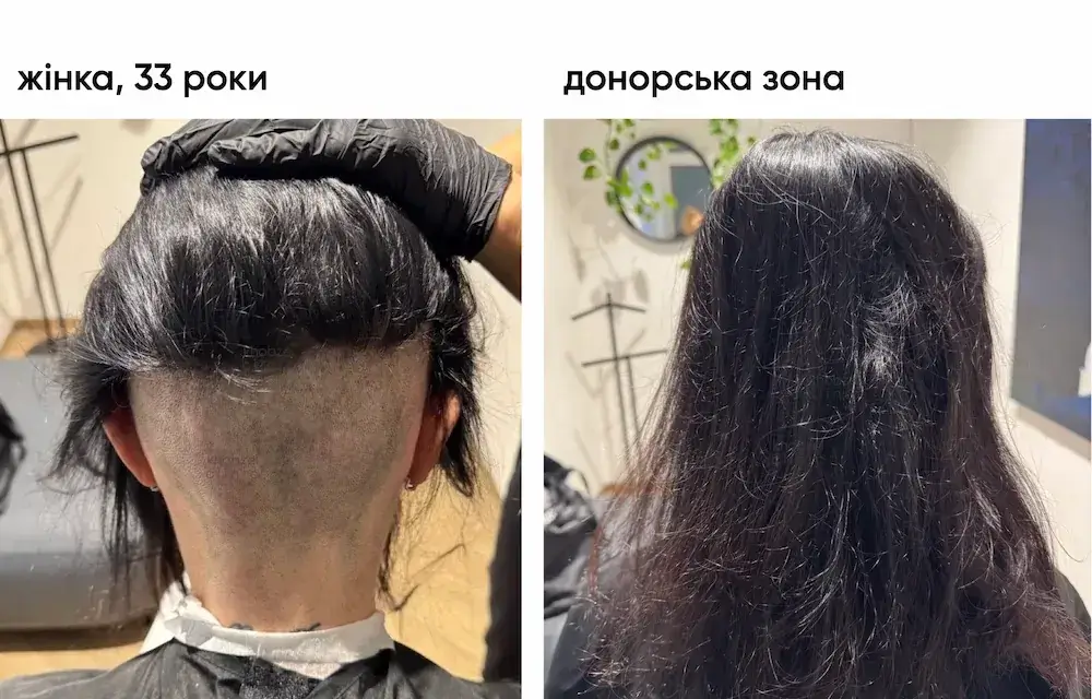 Трансплантация волос у женщины: результат через 6 месяцев 8