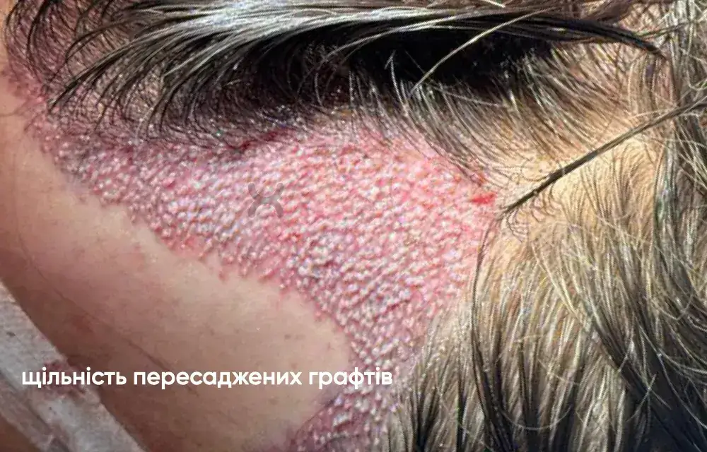 Трансплантація волосся з частковим зістриганням: вигляд одразу після процедури 6