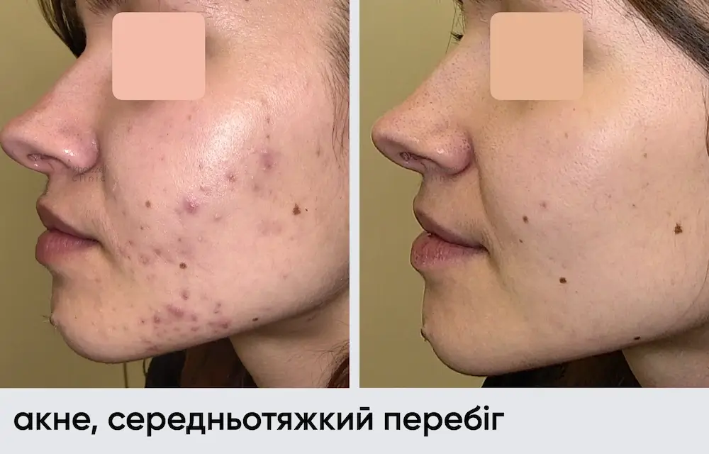 Лечение акне: результат через 14 месяцев