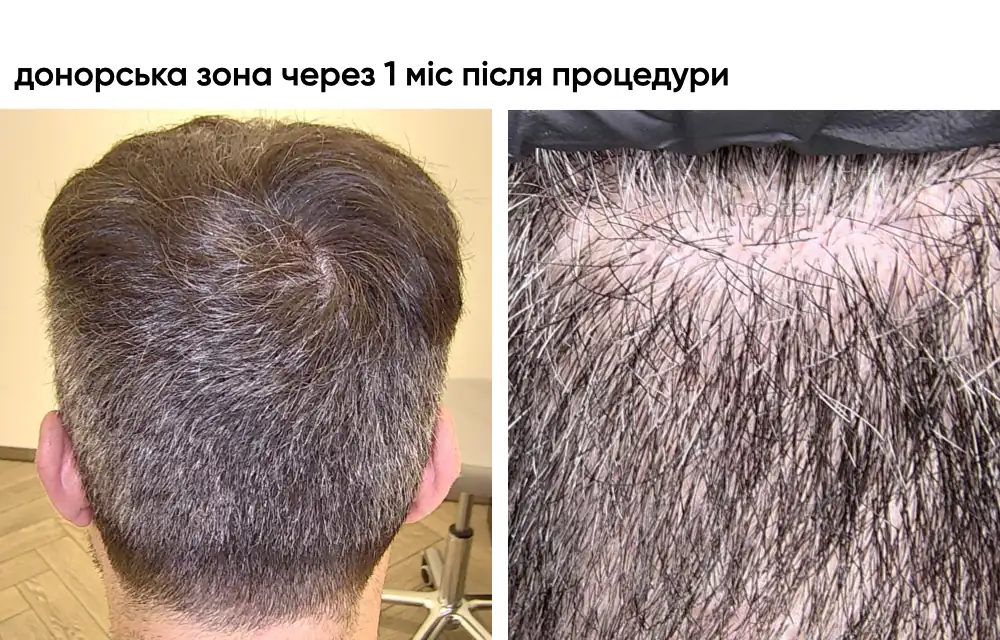Трансплантація волосся з частковим зістриганням: вигляд одразу після процедури 5