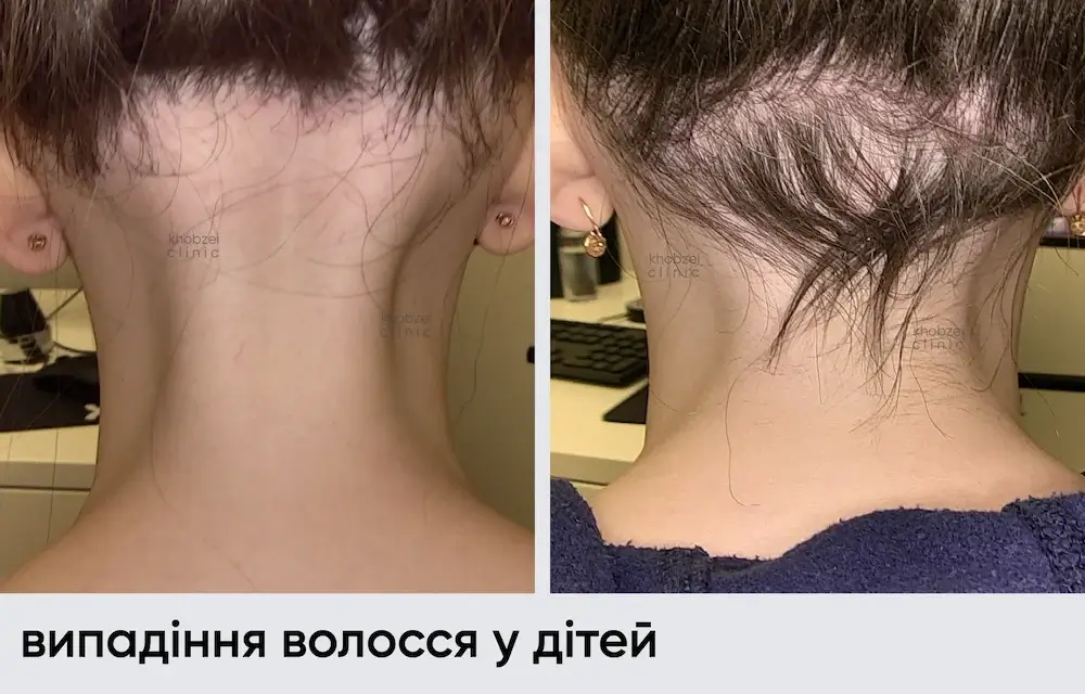 Очаговая алопеция у ребенка: динамика за 11 месяцев лечения