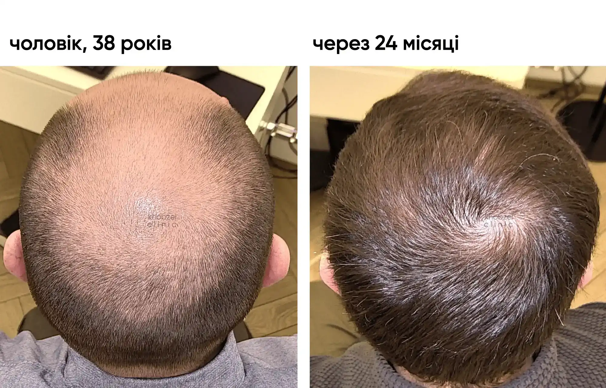 Двоетапна трансплантація волосся: результат через 24 місяці 6