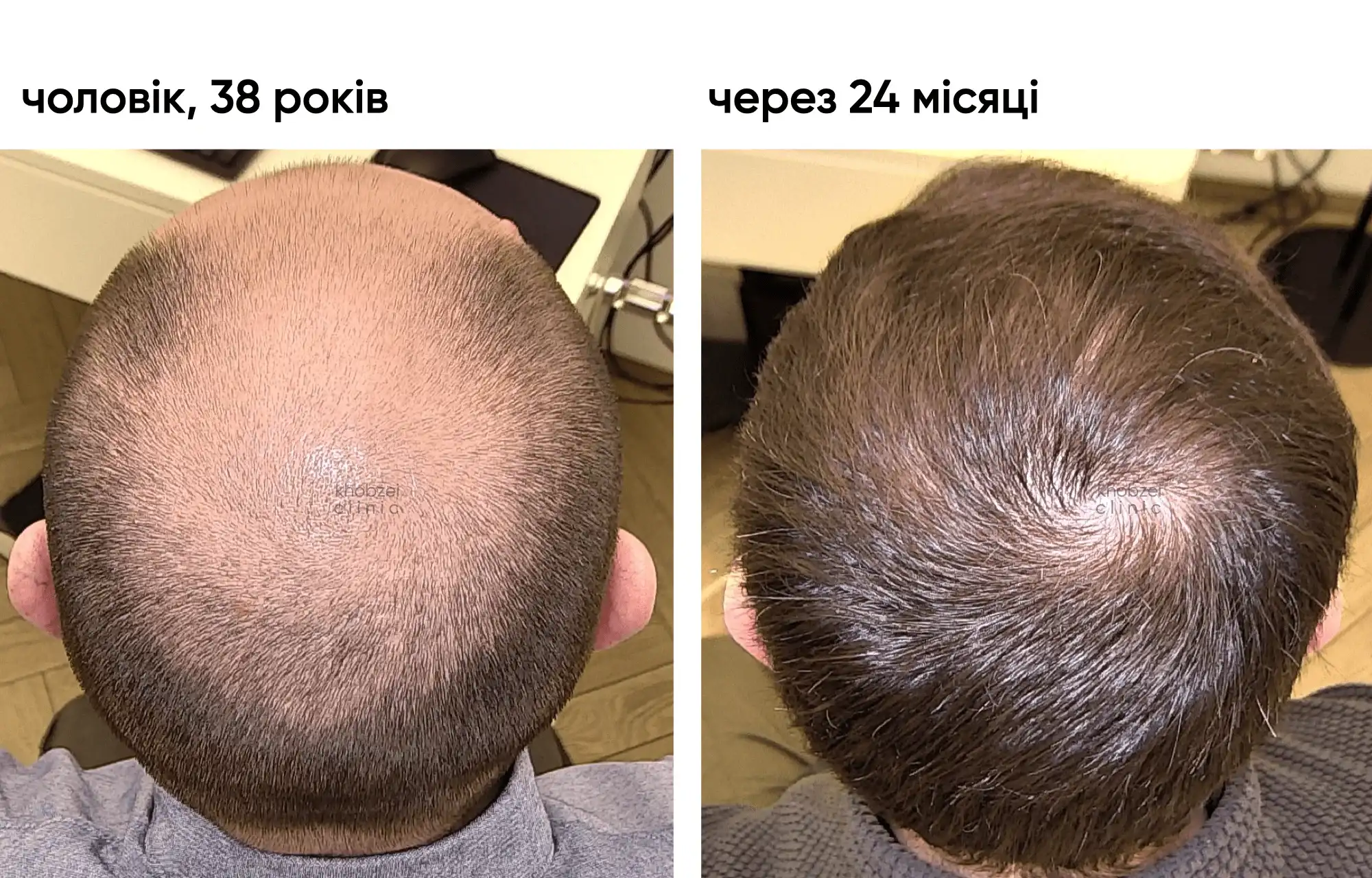 Двухэтапная трансплантация волос: результат через 24 месяца 6
