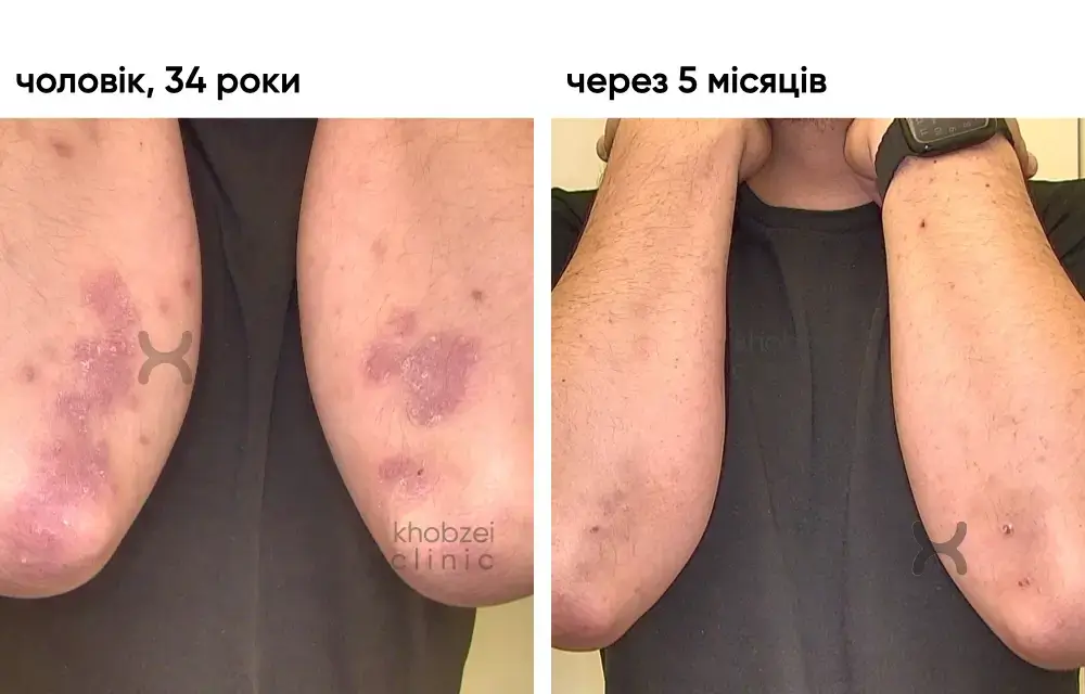 Псоріаз тіла: результат через 5 місяців біологічної терапії 3