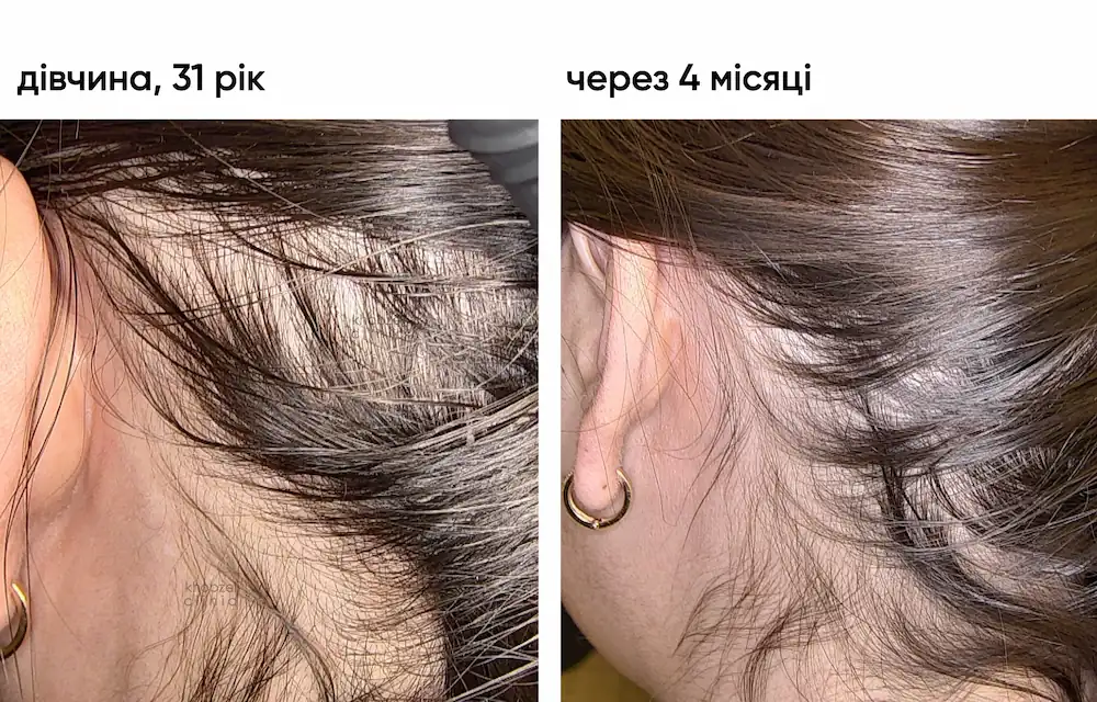 Псоріаз шкіри голови: динаміка через 4 місяці лікування 4
