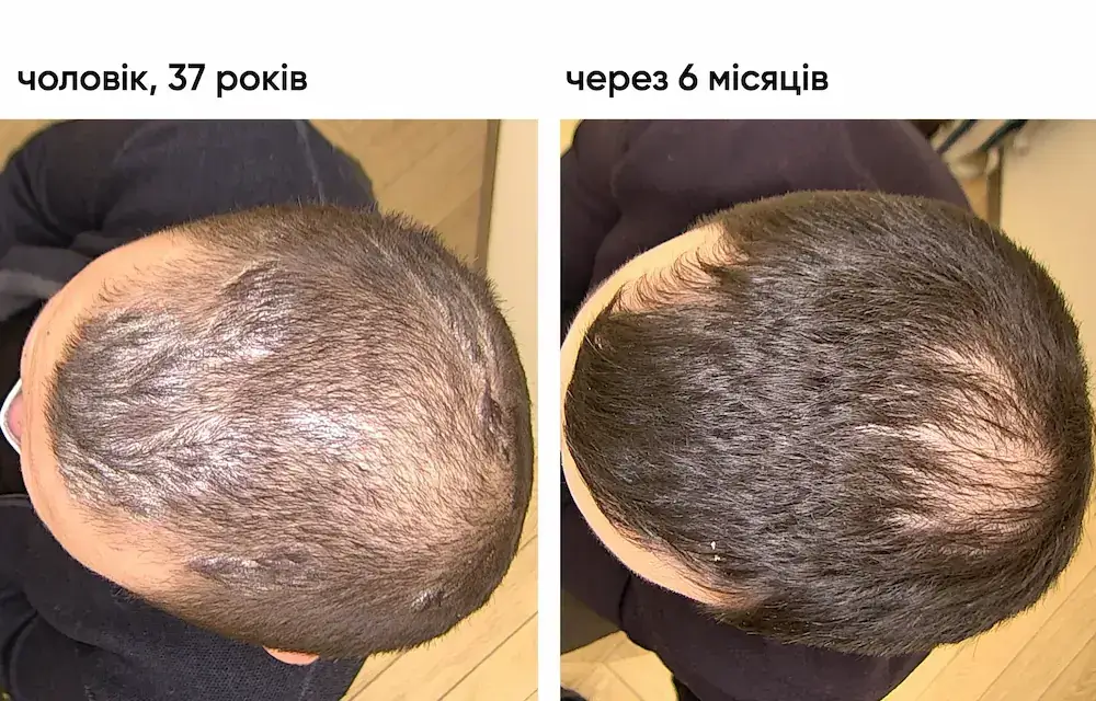 Лікування бляшкового псоріазу: результат через 5 місяців 3