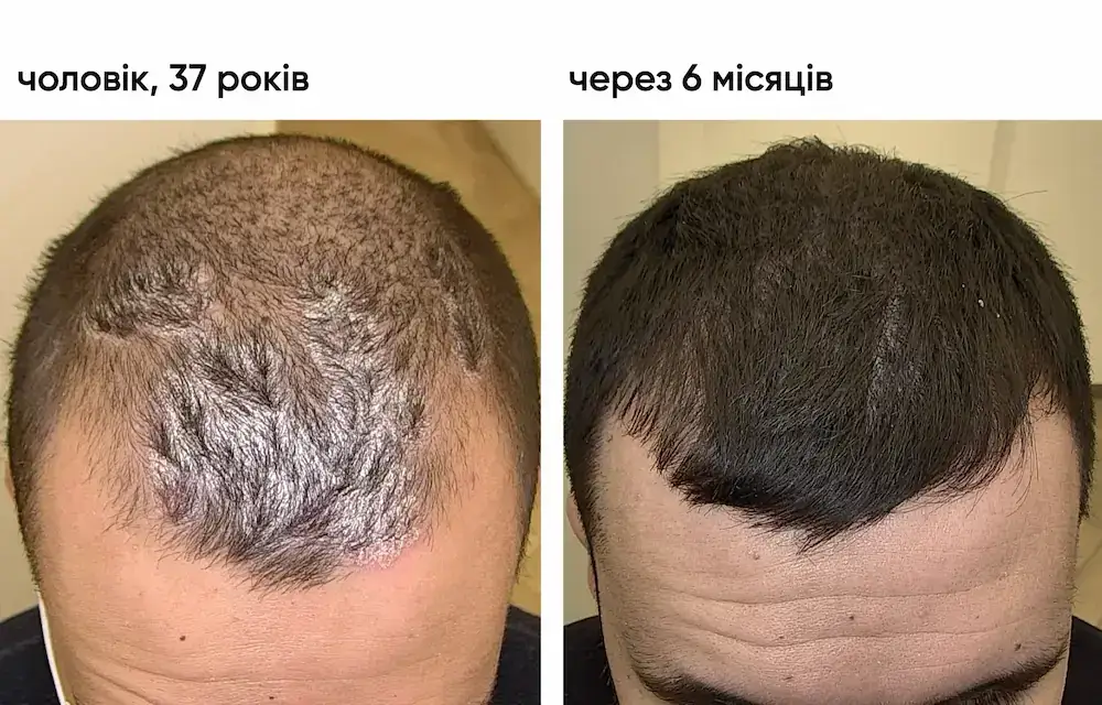 Лікування бляшкового псоріазу: результат через 5 місяців 2