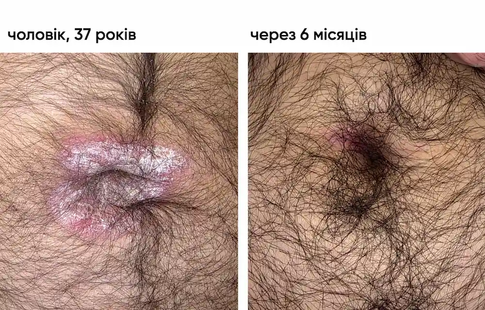 Лікування бляшкового псоріазу: результат через 5 місяців 4