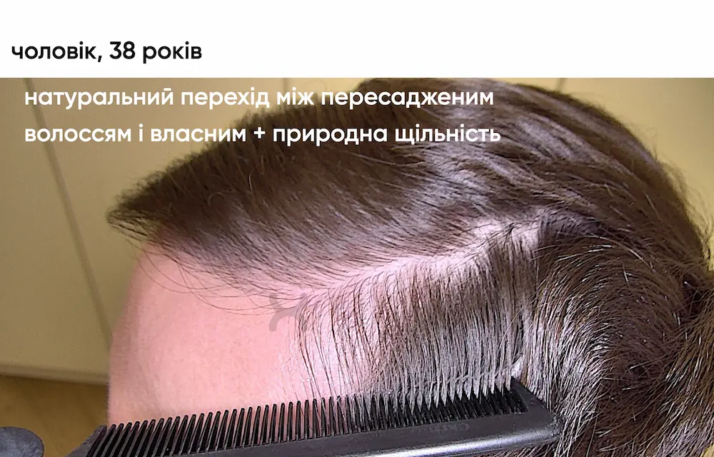 Трансплантація волосся: результат через 30 місяців 9