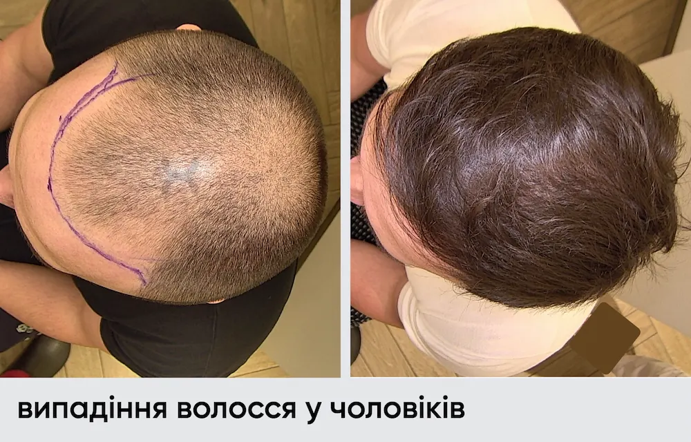 Трансплантація волосся (2050 графтів), результат через 12 місяців 8