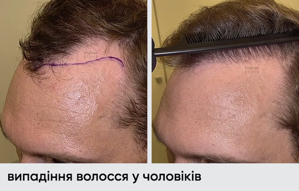 До/После 5