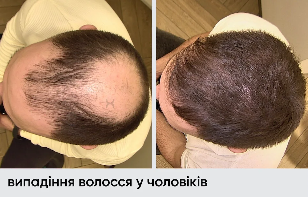 Трансплантация волос: промежуточный результат через 6 месяцев 8