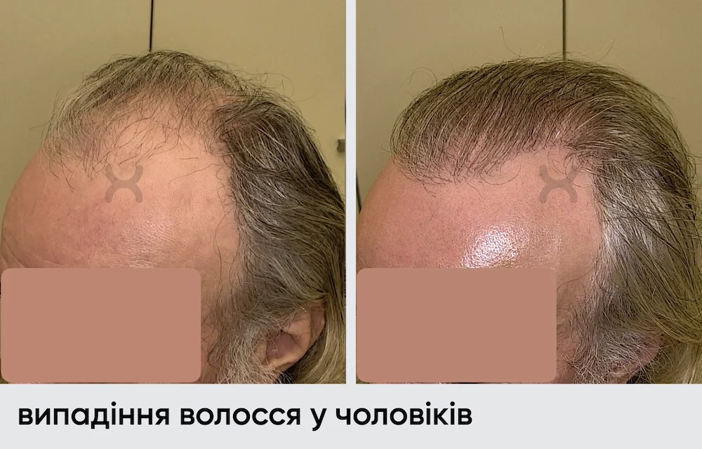 Трансплантация волос: результат через 9 месяцев 8