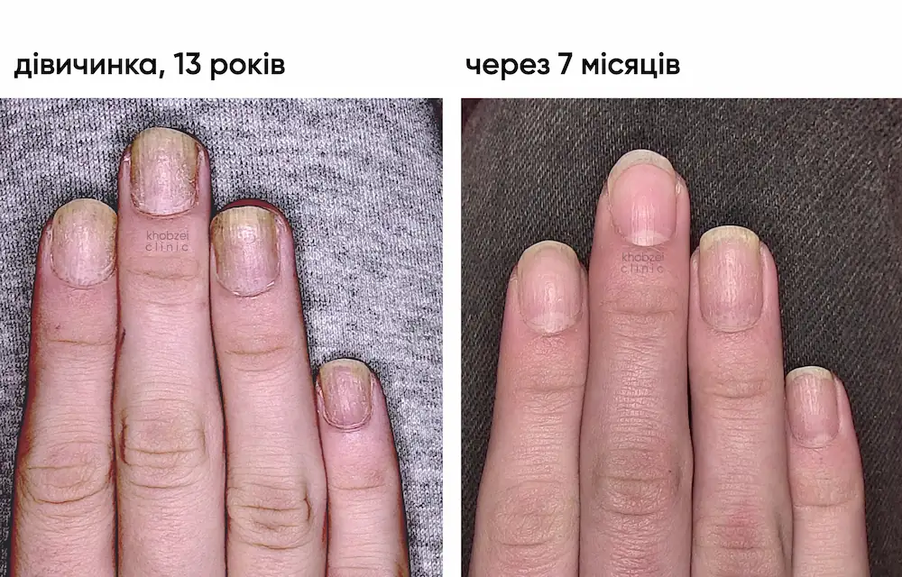 Лікування тотальної гніздової алопеції у дитини: результат через 7 місяців 7