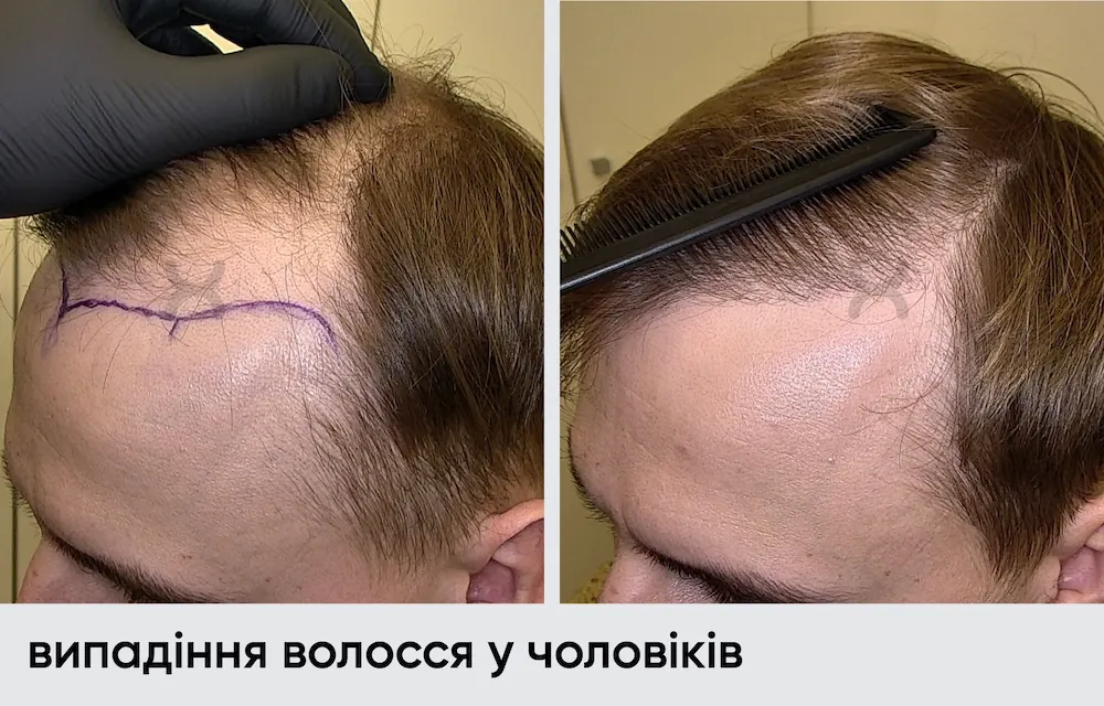 Трансплантация волос: результат через 9 месяцев 9