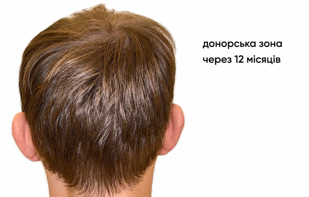Трансплантация волос: результат через 12 месяцев 7
