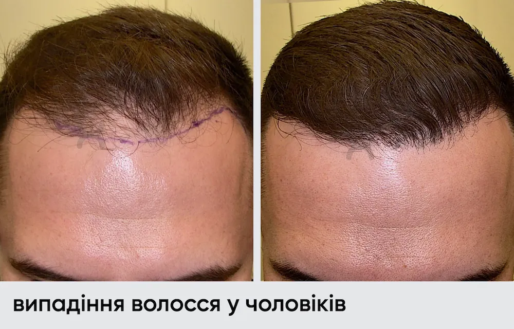 До/После 2