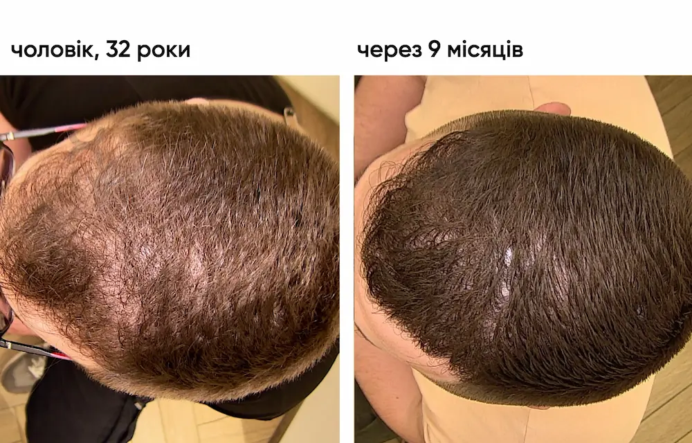 Трансплантація волосся: результат через 9 місяців 5